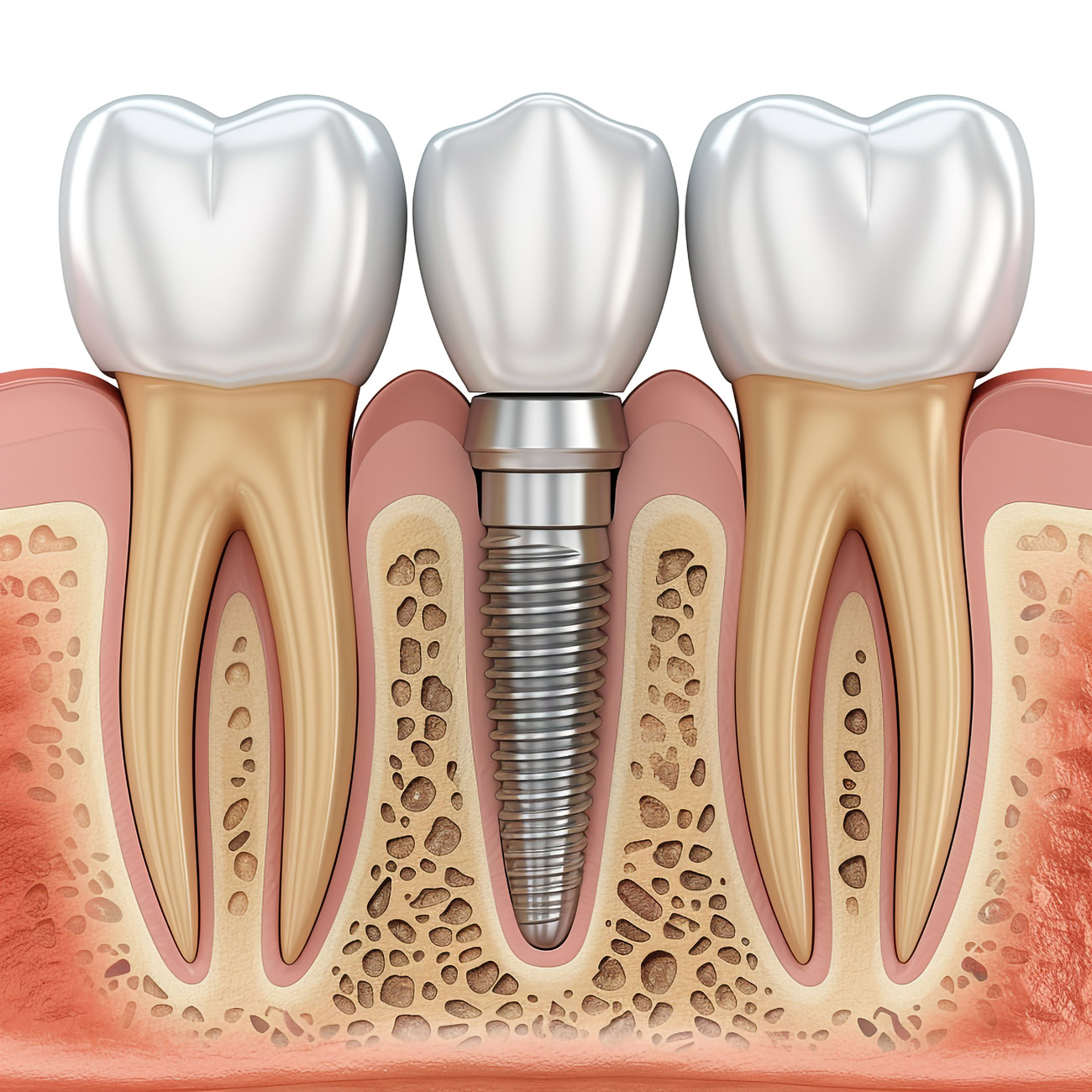 aktif dent implant AKTİF DENT www.aktifdent.com.tr info@italy.com.tr 05399280551